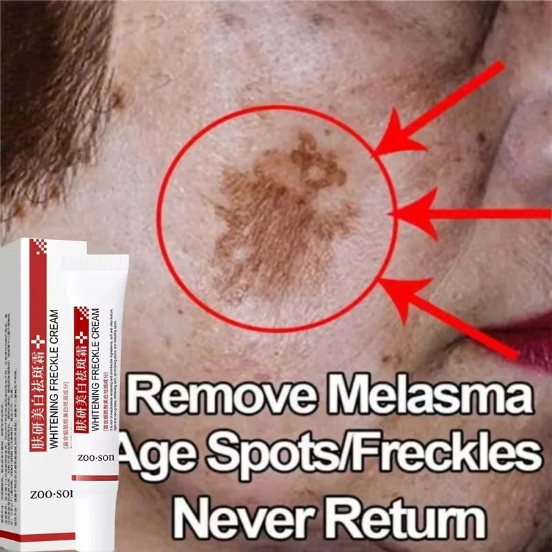 Powerful Spot-removing Whiten Cream Against Pigment Spots Brighten Skin Fade Stain Melanin Moisturize Beauty Korean Skin Care