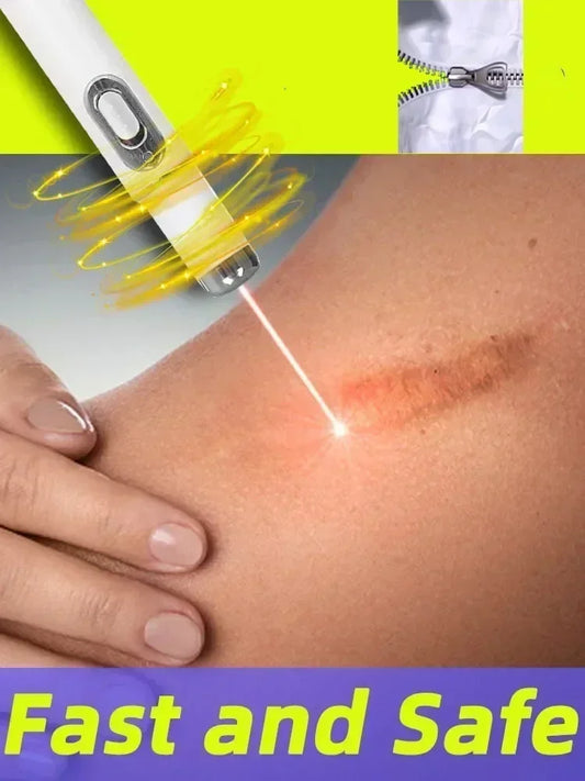 Laser therapy Keloid scar